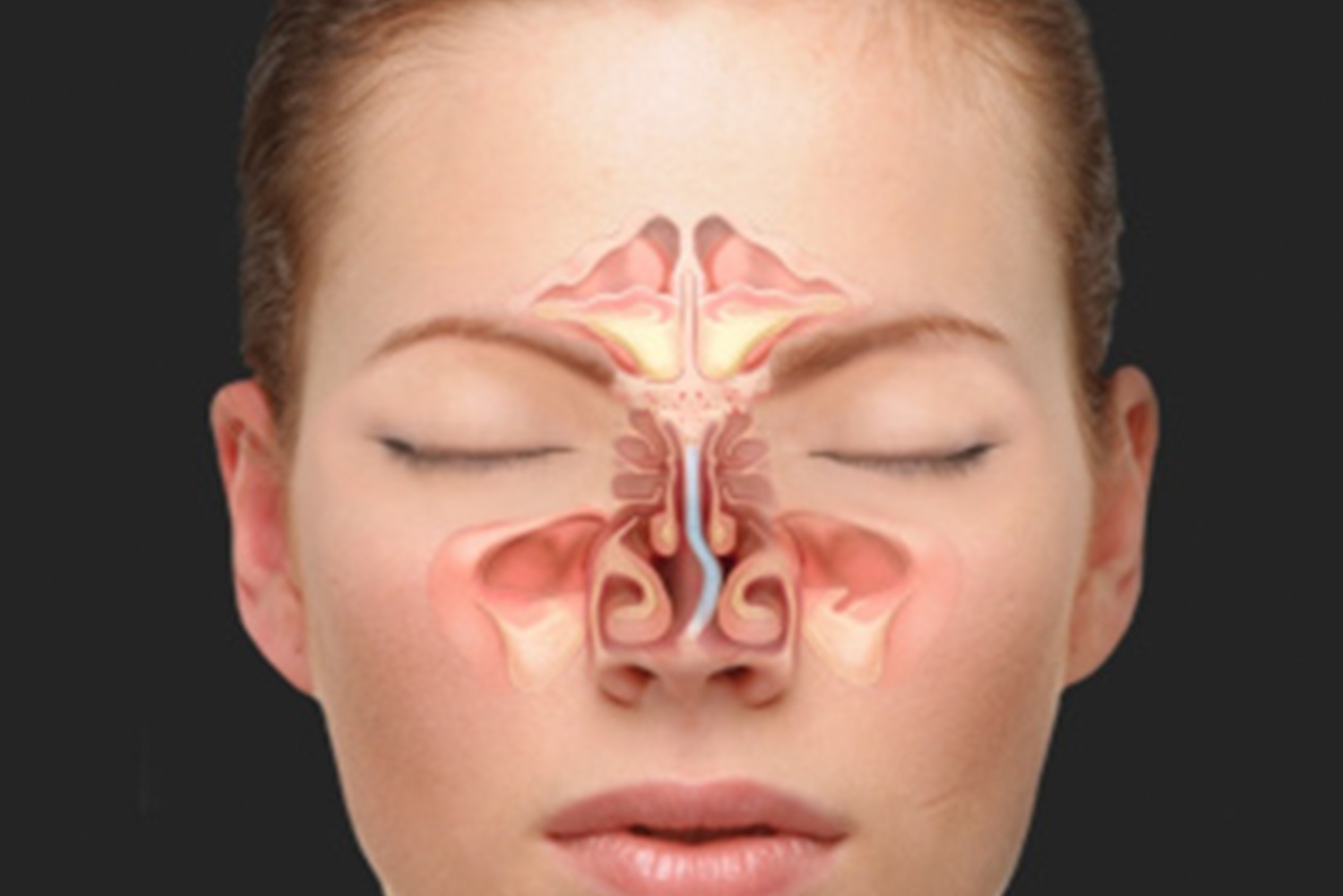 septoplasty